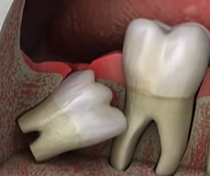 Link to more info about Wisdom Teeth Removal