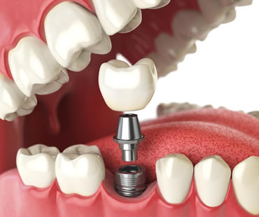 Replacing a Single Tooth with a Dental Implant